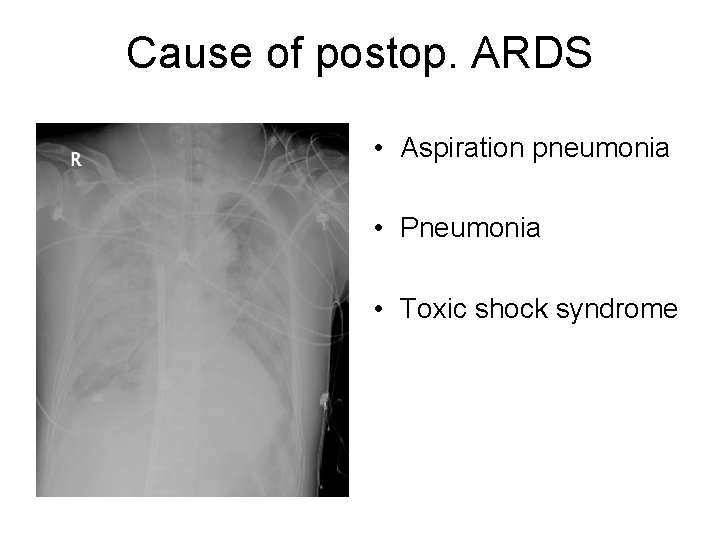 Cause of postop. ARDS • Aspiration pneumonia • Pneumonia • Toxic shock syndrome 