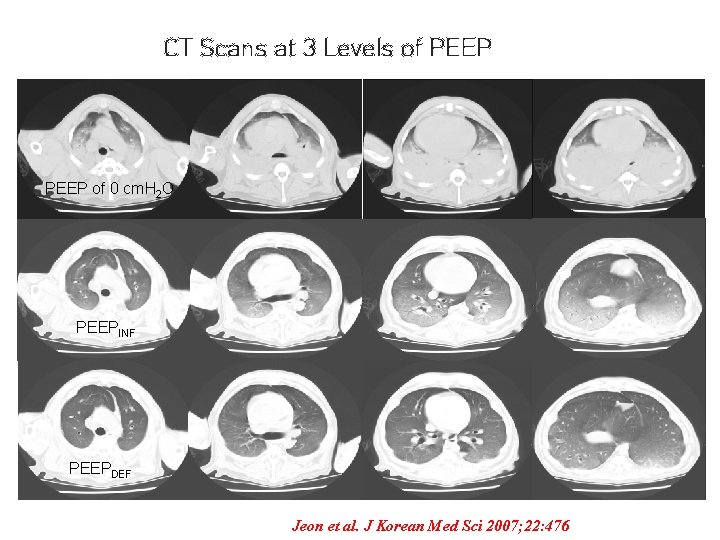 CT Scans at 3 Levels of PEEP of 0 cm. H 2 O PEEPINF