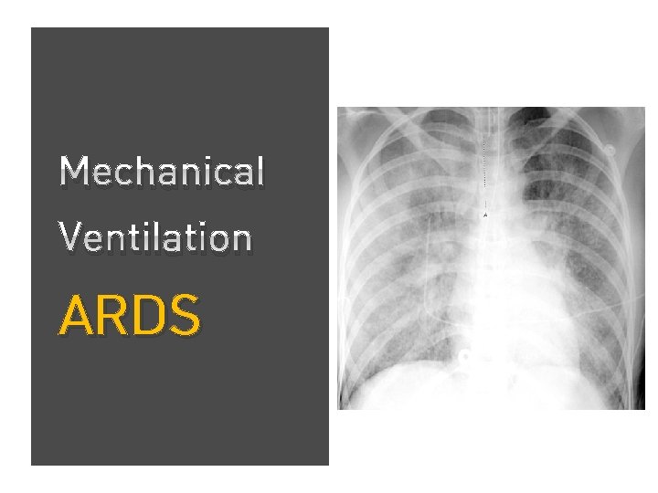 Mechanical Ventilation ARDS 
