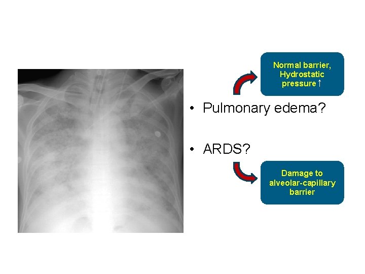 Normal barrier, Hydrostatic pressure↑ • Pulmonary edema? • ARDS? Damage to alveolar-capillary barrier 