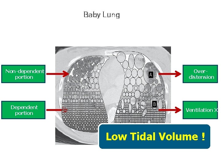 Baby Lung Non-dependent portion Overdistension Dependent portion Ventilation X Low Tidal Volume ! 