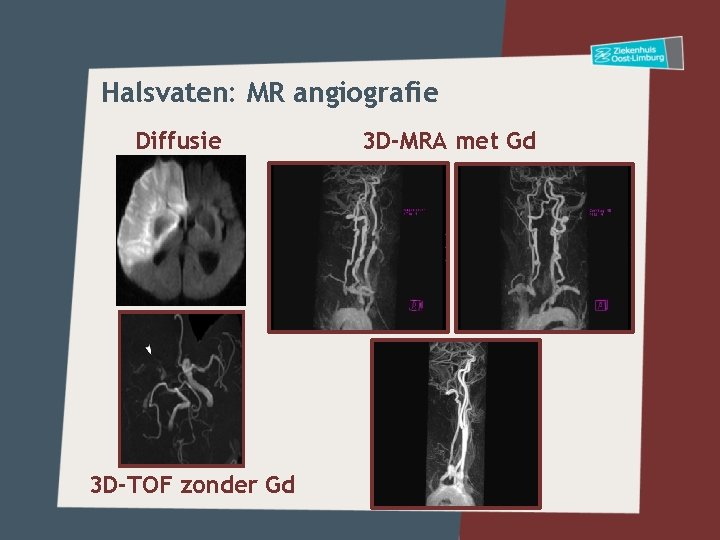 Halsvaten: MR angiografie Diffusie 3 D-TOF zonder Gd 3 D-MRA met Gd 