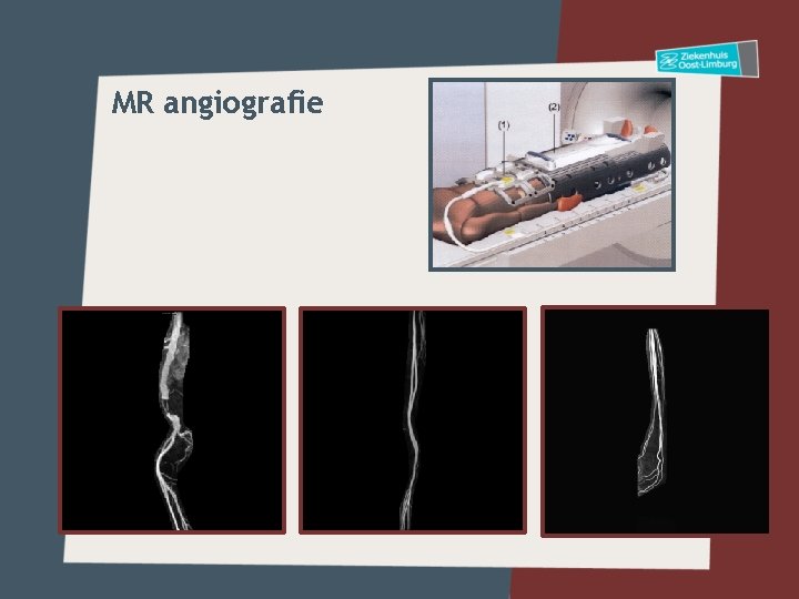 MR angiografie 