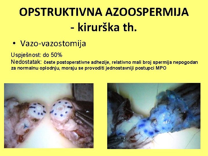 OPSTRUKTIVNA AZOOSPERMIJA - kirurška th. • Vazo-vazostomija Uspješnost: do 50% Nedostatak: česte postoperativne adhezije,