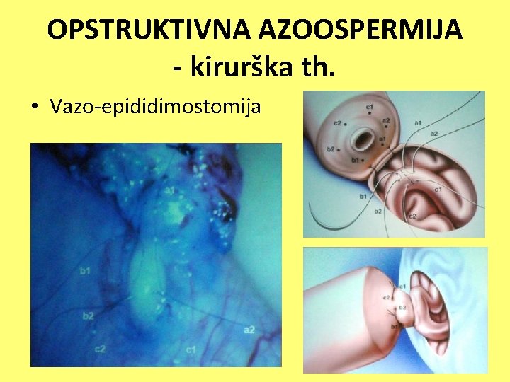 OPSTRUKTIVNA AZOOSPERMIJA - kirurška th. • Vazo-epididimostomija 