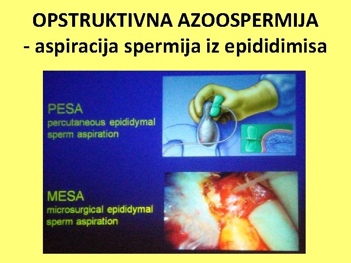 OPSTRUKTIVNA AZOOSPERMIJA - aspiracija spermija iz epididimisa 