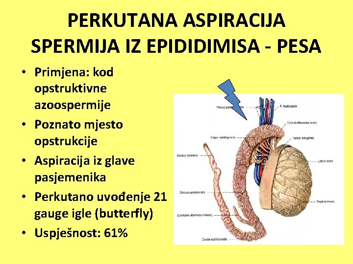 PERKUTANA ASPIRACIJA SPERMIJA IZ EPIDIDIMISA - PESA • Primjena: kod opstruktivne azoospermije • Poznato