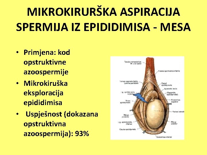 MIKROKIRURŠKA ASPIRACIJA SPERMIJA IZ EPIDIDIMISA - MESA • Primjena: kod opstruktivne azoospermije • Mikrokiruška
