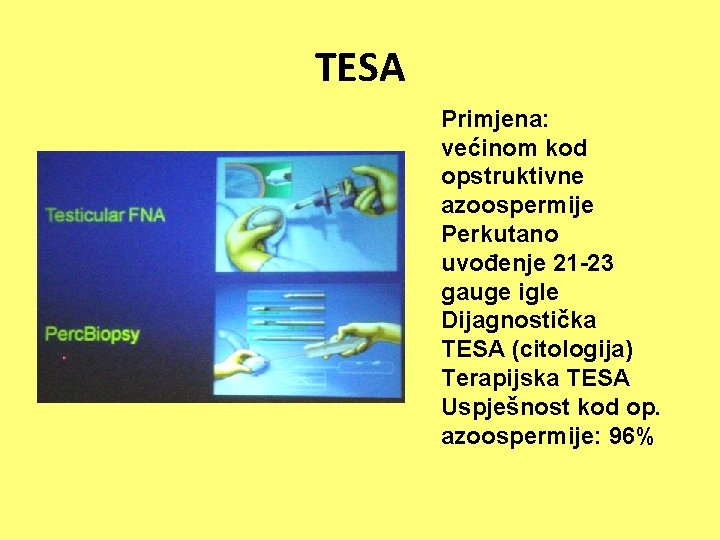 TESA Primjena: većinom kod opstruktivne azoospermije Perkutano uvođenje 21 -23 gauge igle Dijagnostička TESA