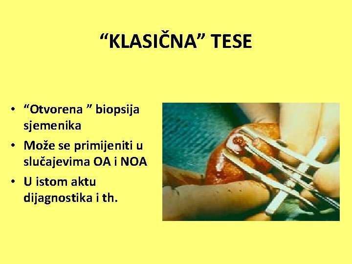 “KLASIČNA” TESE • “Otvorena ” biopsija sjemenika • Može se primijeniti u slučajevima OA