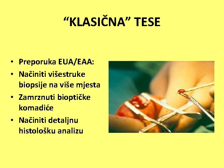 “KLASIČNA” TESE • Preporuka EUA/EAA: • Načiniti višestruke biopsije na više mjesta • Zamrznuti