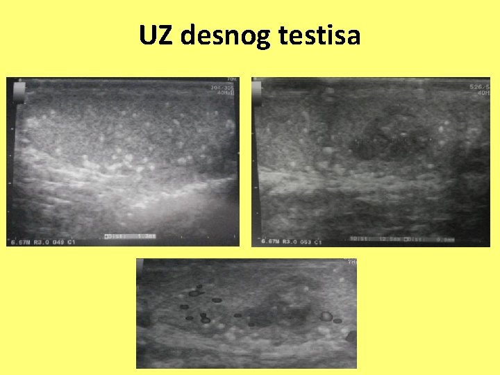 UZ desnog testisa 