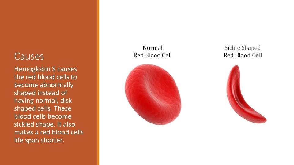 Causes Hemoglobin S causes the red blood cells to become abnormally shaped instead of