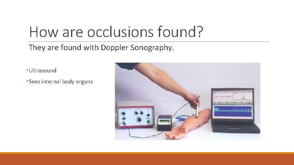 How are occlusions found? They are found with Doppler Sonography. • Ultrasound • Sees