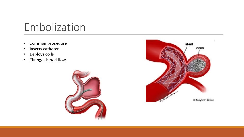 Embolization • • Common procedure Inserts catheter Deploys coils Changes blood flow 