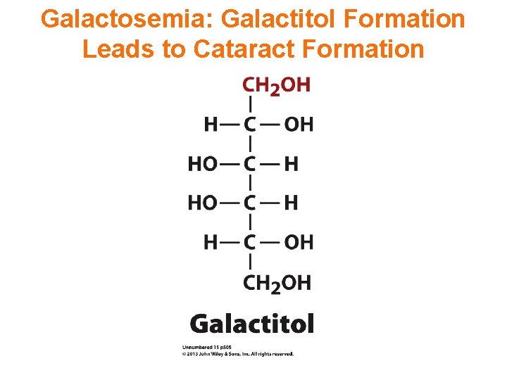 Galactosemia: Galactitol Formation Leads to Cataract Formation 