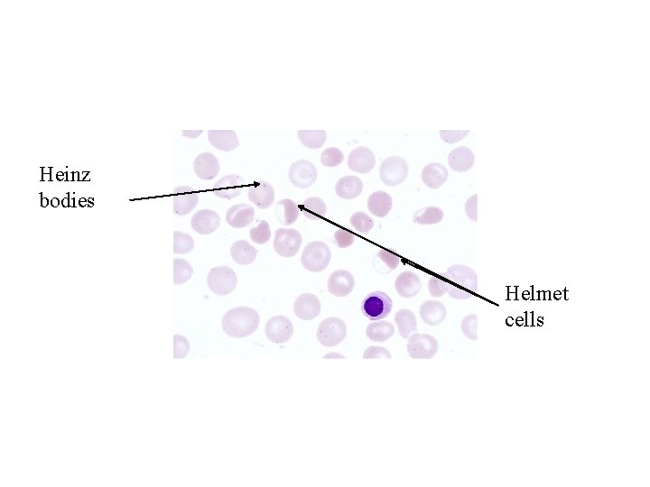 Heinz bodies Helmet cells 
