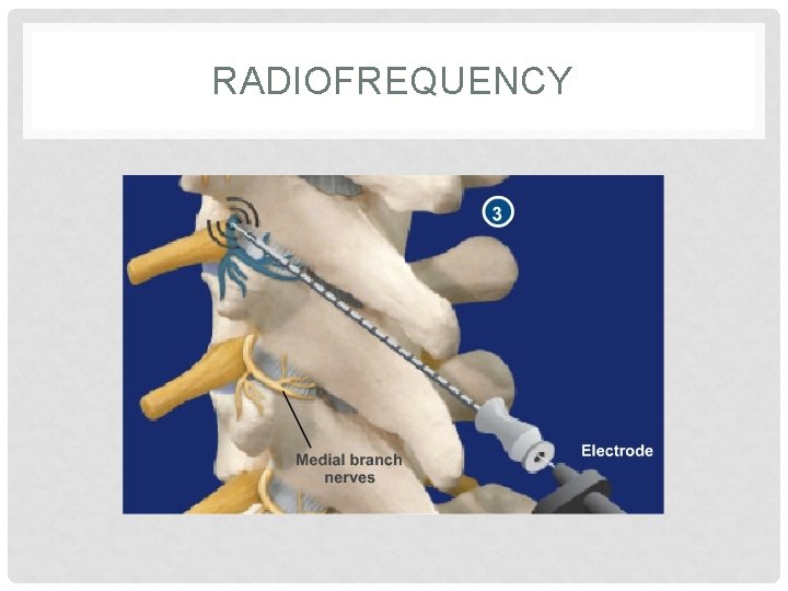 RADIOFREQUENCY 