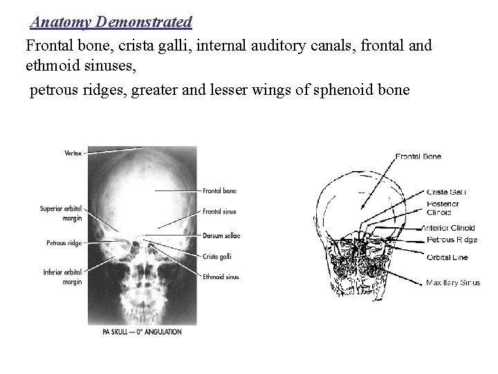 Anatomy Demonstrated Frontal bone, crista galli, internal auditory canals, frontal and ethmoid sinuses, petrous