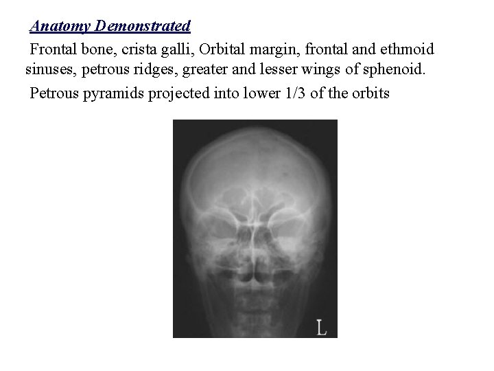 Anatomy Demonstrated Frontal bone, crista galli, Orbital margin, frontal and ethmoid sinuses, petrous ridges,