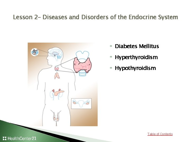 Lesson 2– Diseases and Disorders of the Endocrine System Diabetes Mellitus Hyperthyroidism Hypothyroidism Table