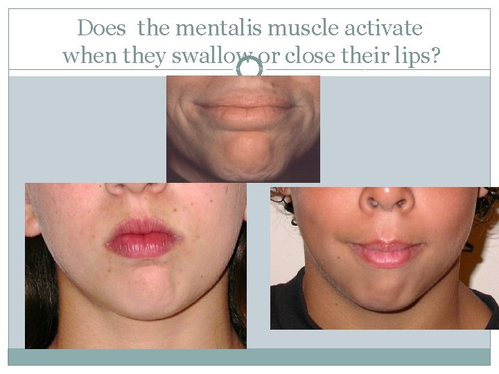 Does the mentalis muscle activate when they swallow or close their lips? 