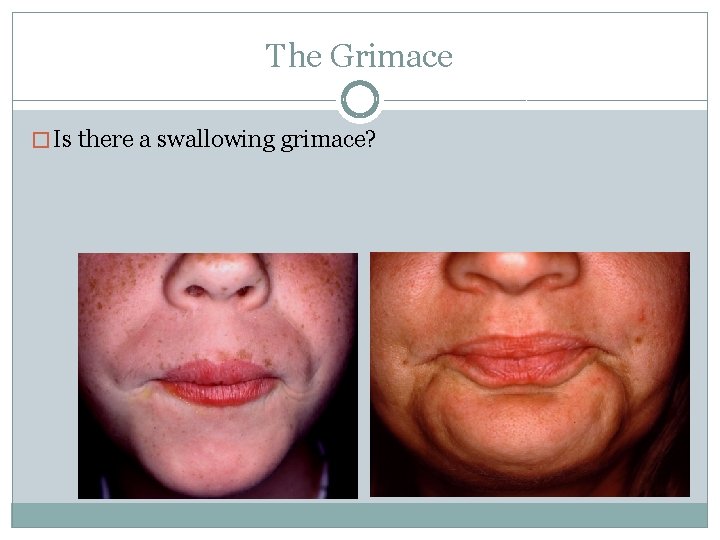 The Grimace � Is there a swallowing grimace? 