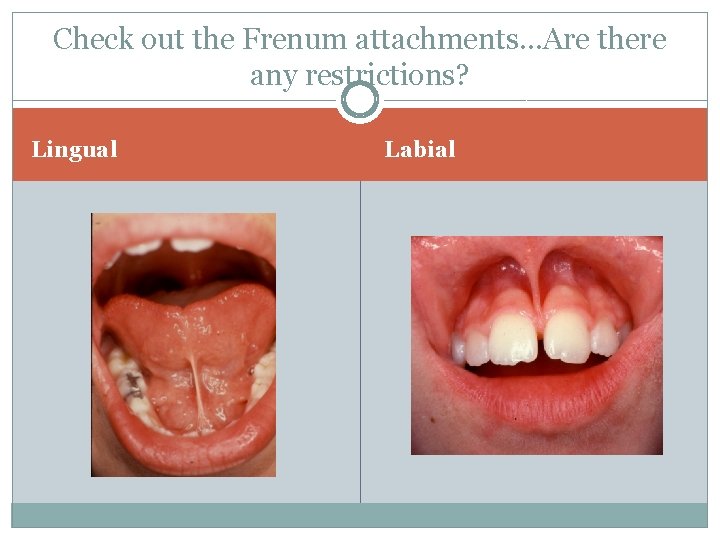 Check out the Frenum attachments…Are there any restrictions? Lingual Labial 