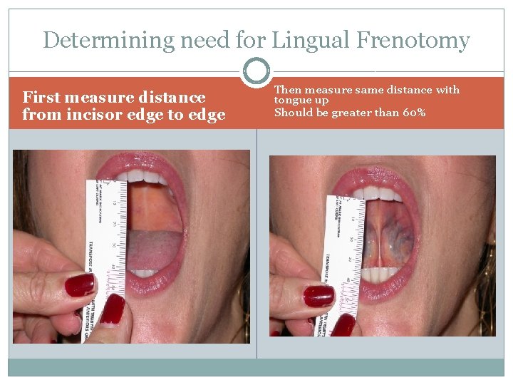 Determining need for Lingual Frenotomy First measure distance from incisor edge to edge Then