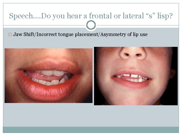 Speech…. Do you hear a frontal or lateral “s” lisp? � Jaw Shift/Incorrect tongue