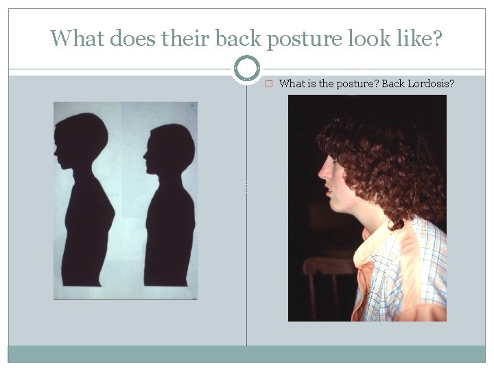 What does their back posture look like? � What is the posture? Back Lordosis?