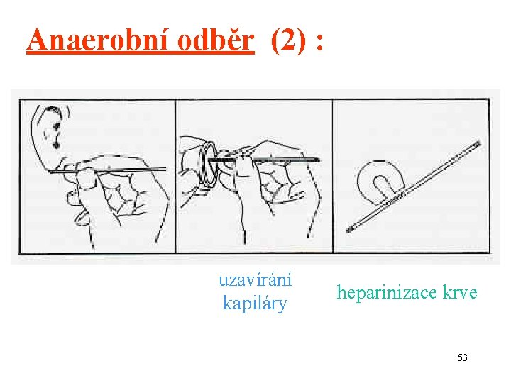 Anaerobní odběr (2) : uzavírání kapiláry heparinizace krve 53 
