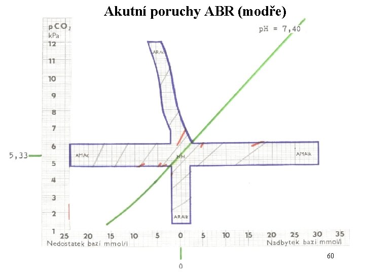 Akutní poruchy ABR (modře) 60 