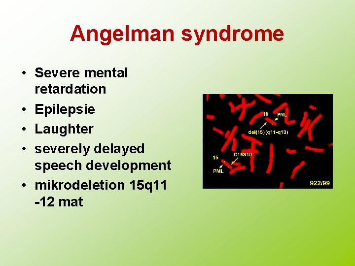 Angelman syndrome • Severe mental retardation • Epilepsie • Laughter • severely delayed speech