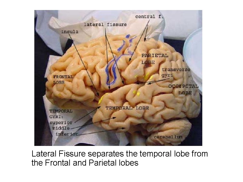 Lateral Fissure separates the temporal lobe from the Frontal and Parietal lobes 