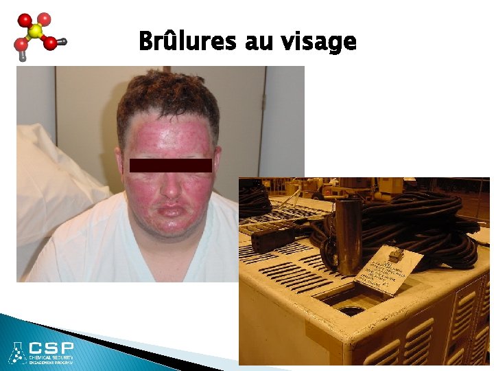 Brûlures au visage 8 