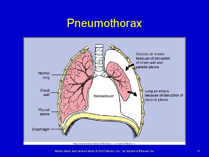 Pneumothorax Mosby items and derived items © 2012 Mosby, Inc. , an imprint of Pneumothorax Mosby items and derived items © 2012 Mosby, Inc. , an imprint of