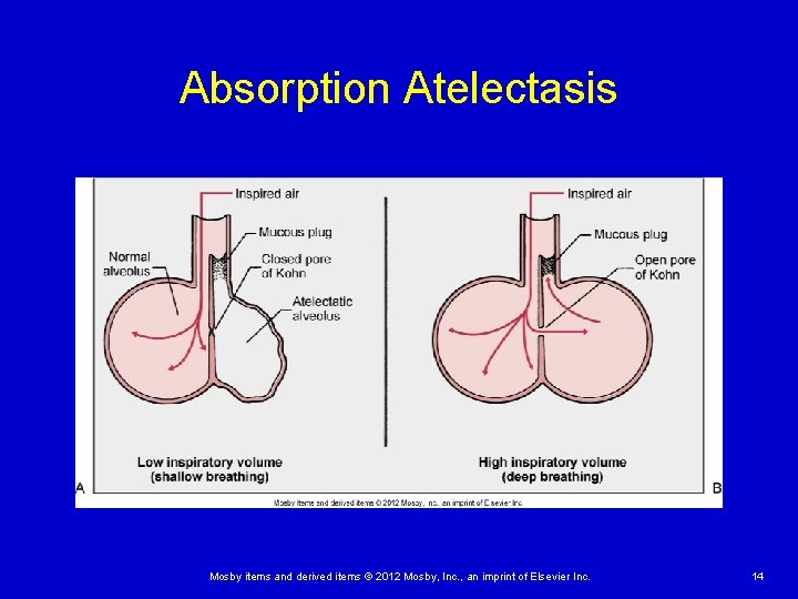 Absorption Atelectasis Mosby items and derived items © 2012 Mosby, Inc. , an imprint Absorption Atelectasis Mosby items and derived items © 2012 Mosby, Inc. , an imprint