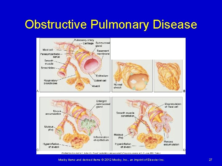 Obstructive Pulmonary Disease Mosby items and derived items © 2012 Mosby, Inc. , an Obstructive Pulmonary Disease Mosby items and derived items © 2012 Mosby, Inc. , an