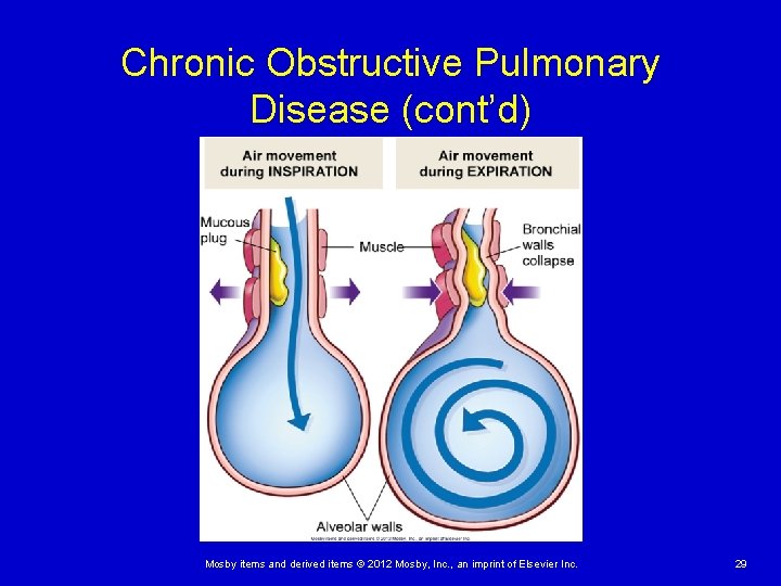 Chronic Obstructive Pulmonary Disease (cont’d) Mosby items and derived items © 2012 Mosby, Inc. Chronic Obstructive Pulmonary Disease (cont’d) Mosby items and derived items © 2012 Mosby, Inc.