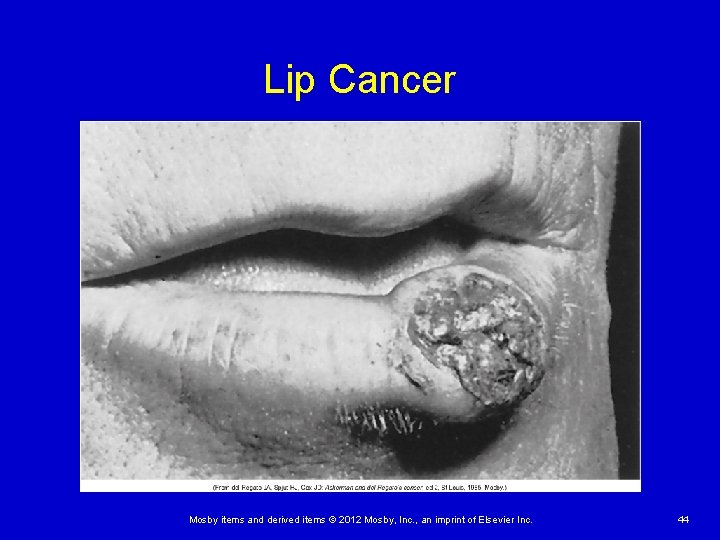 Lip Cancer Mosby items and derived items © 2012 Mosby, Inc. , an imprint Lip Cancer Mosby items and derived items © 2012 Mosby, Inc. , an imprint