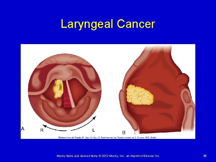 Laryngeal Cancer Mosby items and derived items © 2012 Mosby, Inc. , an imprint Laryngeal Cancer Mosby items and derived items © 2012 Mosby, Inc. , an imprint