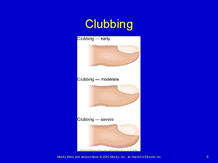 Clubbing Mosby items and derived items © 2012 Mosby, Inc. , an imprint of Clubbing Mosby items and derived items © 2012 Mosby, Inc. , an imprint of