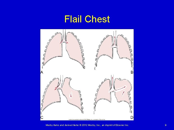 Flail Chest Mosby items and derived items © 2012 Mosby, Inc. , an imprint Flail Chest Mosby items and derived items © 2012 Mosby, Inc. , an imprint