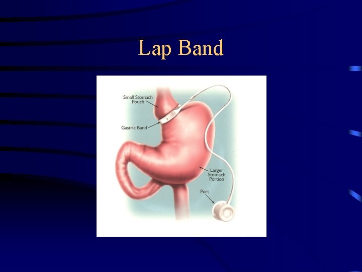 Lap Band 