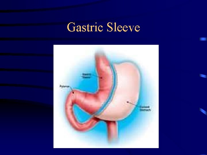 Gastric Sleeve 