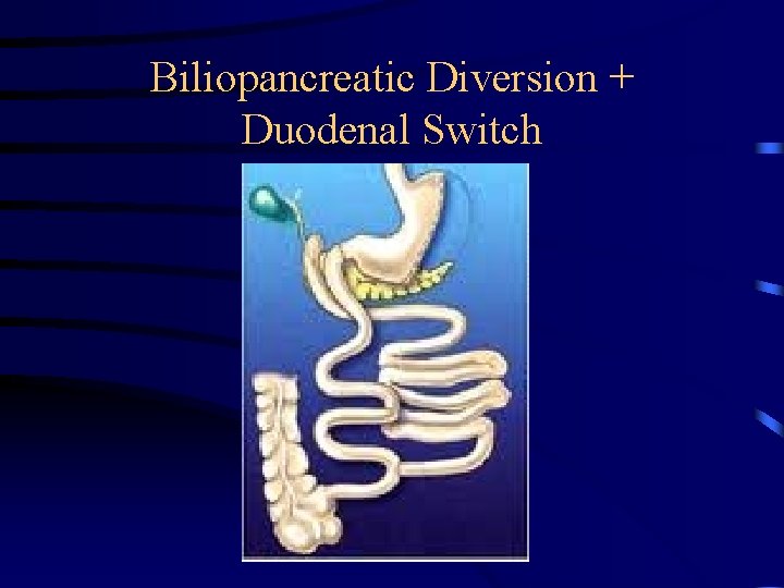 Biliopancreatic Diversion + Duodenal Switch 