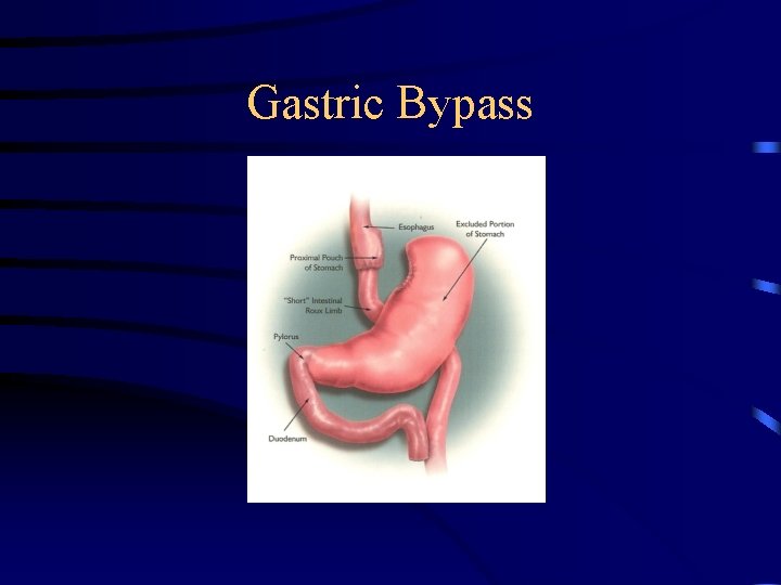 Gastric Bypass 