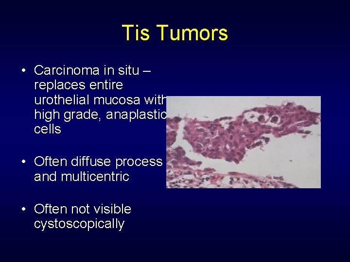 Tis Tumors • Carcinoma in situ – replaces entire urothelial mucosa with high grade,