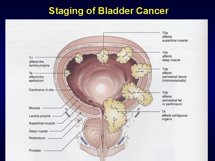 Staging of Bladder Cancer 